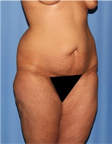 Body Lift Before Photo by Siamak Agha, MD PhD FACS; Newport Beach, CA - Case 43950