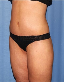 Body Lift After Photo by Siamak Agha, MD PhD FACS; Newport Beach, CA - Case 43950