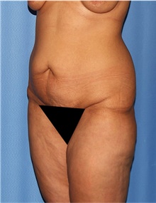 Body Lift Before Photo by Siamak Agha, MD PhD FACS; Newport Beach, CA - Case 43950