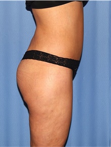 Body Lift After Photo by Siamak Agha, MD PhD FACS; Newport Beach, CA - Case 43950