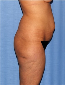 Body Lift Before Photo by Siamak Agha, MD PhD FACS; Newport Beach, CA - Case 43950