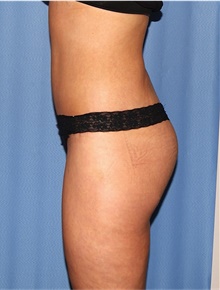 Body Lift After Photo by Siamak Agha, MD PhD FACS; Newport Beach, CA - Case 43950