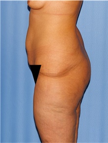 Body Lift Before Photo by Siamak Agha, MD PhD FACS; Newport Beach, CA - Case 43950