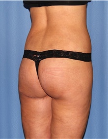 Body Lift After Photo by Siamak Agha, MD PhD FACS; Newport Beach, CA - Case 43950