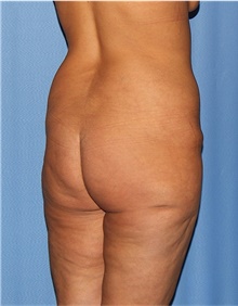 Body Lift Before Photo by Siamak Agha, MD PhD FACS; Newport Beach, CA - Case 43950