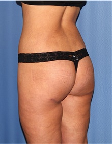 Body Lift After Photo by Siamak Agha, MD PhD FACS; Newport Beach, CA - Case 43950