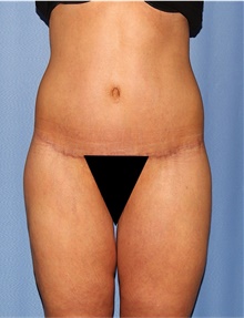 Body Lift After Photo by Siamak Agha, MD PhD FACS; Newport Beach, CA - Case 43950