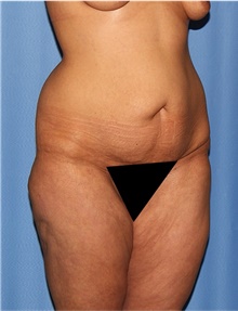 Body Lift Before Photo by Siamak Agha, MD PhD FACS; Newport Beach, CA - Case 43950