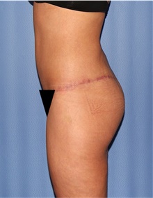 Body Lift After Photo by Siamak Agha, MD PhD FACS; Newport Beach, CA - Case 43950