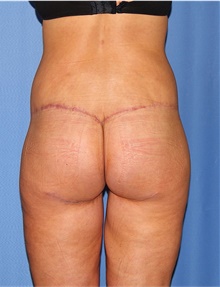 Body Lift After Photo by Siamak Agha, MD PhD FACS; Newport Beach, CA - Case 43950