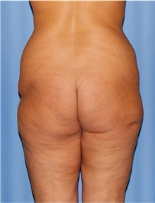 Body Lift Before Photo by Siamak Agha, MD PhD FACS; Newport Beach, CA - Case 43950