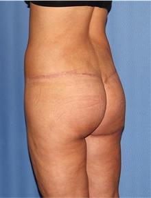 Body Lift After Photo by Siamak Agha, MD PhD FACS; Newport Beach, CA - Case 43950
