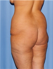Body Lift Before Photo by Siamak Agha, MD PhD FACS; Newport Beach, CA - Case 43950