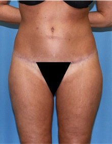 Body Lift After Photo by Siamak Agha, MD PhD FACS; Newport Beach, CA - Case 43958