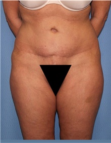 Body Lift Before Photo by Siamak Agha, MD PhD FACS; Newport Beach, CA - Case 43958