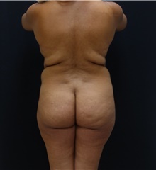 Buttock Lift with Augmentation Before Photo by Johnny Franco, MD; Austin, TX - Case 43971