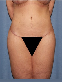 Body Lift After Photo by Siamak Agha, MD PhD FACS; Newport Beach, CA - Case 43983
