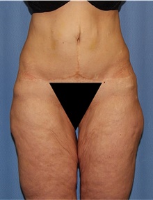 Body Lift Before Photo by Siamak Agha, MD PhD FACS; Newport Beach, CA - Case 43983