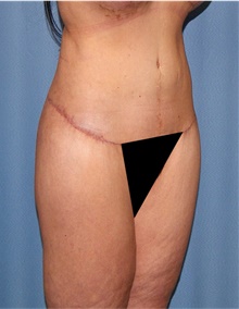 Body Lift After Photo by Siamak Agha, MD PhD FACS; Newport Beach, CA - Case 43983