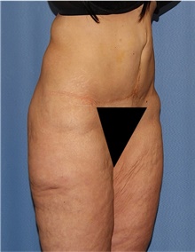 Body Lift Before Photo by Siamak Agha, MD PhD FACS; Newport Beach, CA - Case 43983