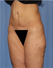 Body Lift Before Photo by Siamak Agha, MD PhD FACS; Newport Beach, CA - Case 43983
