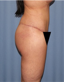 Body Lift After Photo by Siamak Agha, MD PhD FACS; Newport Beach, CA - Case 43983