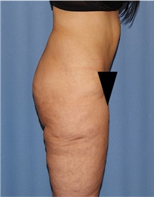 Body Lift Before Photo by Siamak Agha, MD PhD FACS; Newport Beach, CA - Case 43983