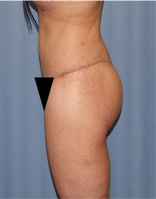Body Lift After Photo by Siamak Agha, MD PhD FACS; Newport Beach, CA - Case 43983