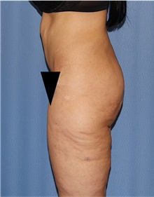 Body Lift Before Photo by Siamak Agha, MD PhD FACS; Newport Beach, CA - Case 43983