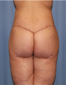 Body Lift After Photo by Siamak Agha, MD PhD FACS; Newport Beach, CA - Case 43983
