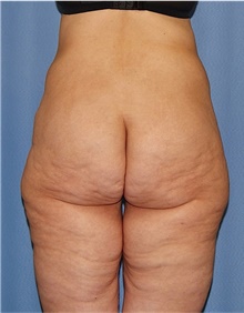 Body Lift Before Photo by Siamak Agha, MD PhD FACS; Newport Beach, CA - Case 43983