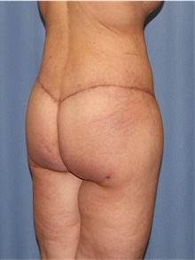 Body Lift After Photo by Siamak Agha, MD PhD FACS; Newport Beach, CA - Case 43983