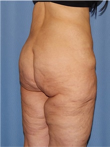 Body Lift Before Photo by Siamak Agha, MD PhD FACS; Newport Beach, CA - Case 43983