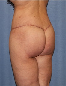 Body Lift After Photo by Siamak Agha, MD PhD FACS; Newport Beach, CA - Case 43983