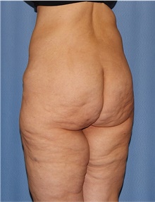 Body Lift Before Photo by Siamak Agha, MD PhD FACS; Newport Beach, CA - Case 43983
