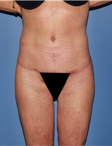 Body Lift After Photo by Siamak Agha, MD PhD FACS; Newport Beach, CA - Case 43989
