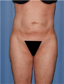 Body Lift Before Photo by Siamak Agha, MD PhD FACS; Newport Beach, CA - Case 43989