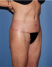 Body Lift After Photo by Siamak Agha, MD PhD FACS; Newport Beach, CA - Case 43989