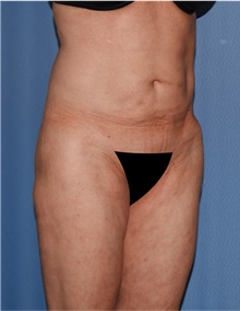 Body Lift Before Photo by Siamak Agha, MD PhD FACS; Newport Beach, CA - Case 43989