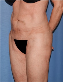 Body Lift Before Photo by Siamak Agha, MD PhD FACS; Newport Beach, CA - Case 43989
