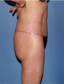 Body Lift After Photo by Siamak Agha, MD PhD FACS; Newport Beach, CA - Case 43989