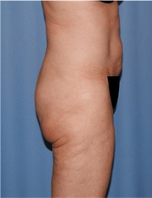 Body Lift Before Photo by Siamak Agha, MD PhD FACS; Newport Beach, CA - Case 43989