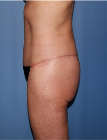 Body Lift After Photo by Siamak Agha, MD PhD FACS; Newport Beach, CA - Case 43989