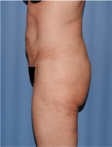 Body Lift Before Photo by Siamak Agha, MD PhD FACS; Newport Beach, CA - Case 43989