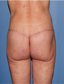 Body Lift After Photo by Siamak Agha, MD PhD FACS; Newport Beach, CA - Case 43989