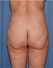 Body Lift Before Photo by Siamak Agha, MD PhD FACS; Newport Beach, CA - Case 43989