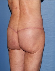 Body Lift After Photo by Siamak Agha, MD PhD FACS; Newport Beach, CA - Case 43989