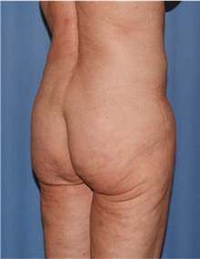 Body Lift Before Photo by Siamak Agha, MD PhD FACS; Newport Beach, CA - Case 43989