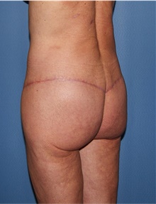 Body Lift After Photo by Siamak Agha, MD PhD FACS; Newport Beach, CA - Case 43989