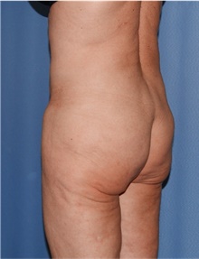 Body Lift Before Photo by Siamak Agha, MD PhD FACS; Newport Beach, CA - Case 43989